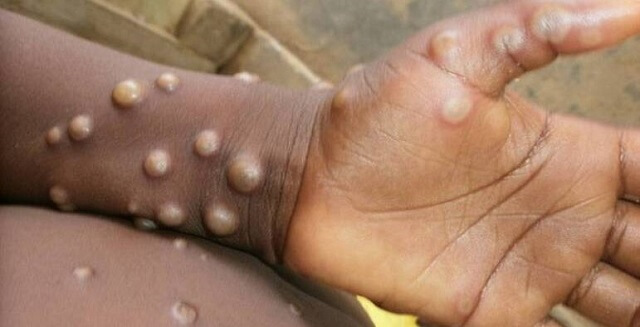 Terceiro caso de Monkeypox é confirmado no Amazonas